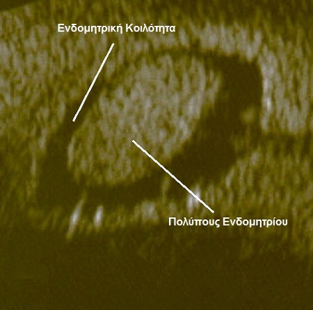 Εικόνα 2: Υπερηχογραφική απεικόνιση πολύποδα ενδομητρίου