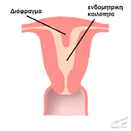 Εικόνα 1: Επίμηκες διάφραγμα της ενδομητρικής κοιλότητος