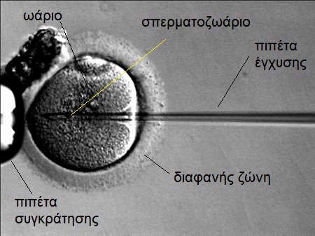 Εικόνα: Ενδοκυτοπλασμική Έγχυση Σπέρματος