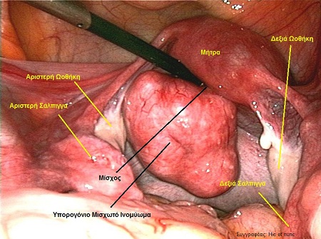 Φωτογραφία: Λαπαροσκοπική Ινομυωματεκτομή