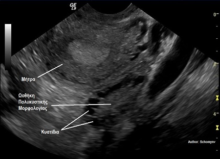 Φωτογραφία: Υπερηχογραφική εικόνα πολυκυστικής ωοθήκης