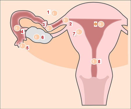 Εικόνα: Θέσεις εμφύτευσης εξωμήτριου κύησης