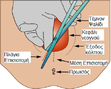 Εικόνα 3: Η Επισιοτομή.