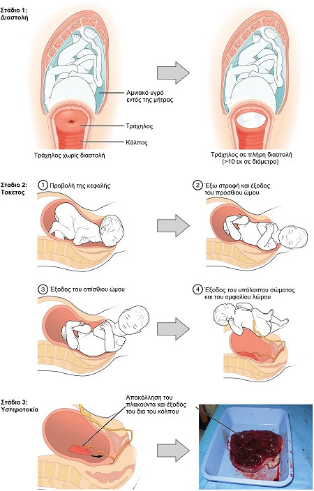 Εικόνα: Τα τρία στάδια του φυσιολογικού τοκετού.