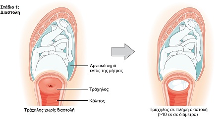 Εικόνα: Το πρώτο στάδιο του τοκετού.