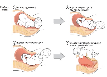 Εικόνα 2: Το δεύτερο στάδιο του τοκετού.