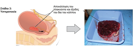 Εικόνα 2: Το τρίτο στάδιο του τοκετού.