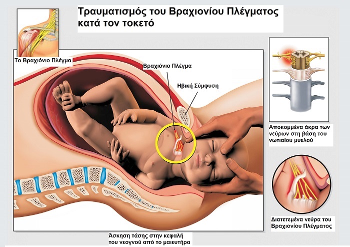 Εικόνα 3: Τραυματισμός του Βραχιόνιου Πλέγματος κατά τον τοκετό