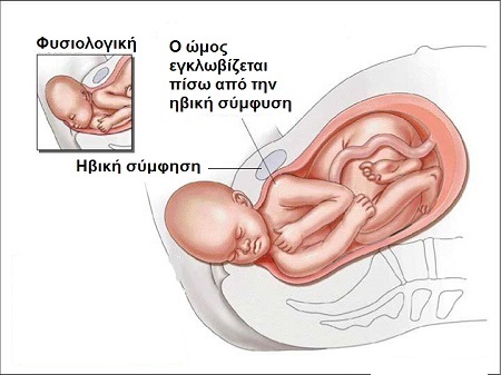 Εικόνα 1: Δυστοκία Ώμων